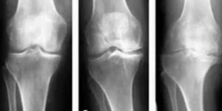 Gonarthrose 3 degrés