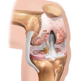 Usure du cartilage