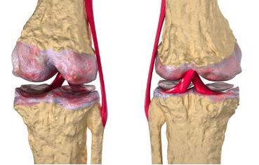 Varices du développement de la gonarthrose