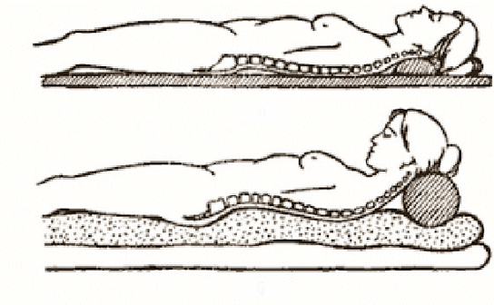 Figure de l'ostéochondrose