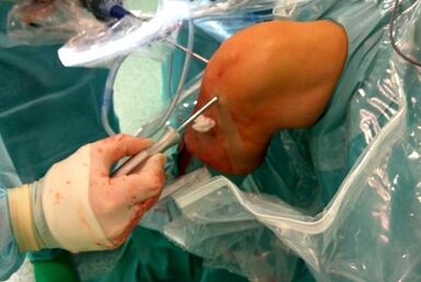 Intervention chirurgicale pour l'arthrose
