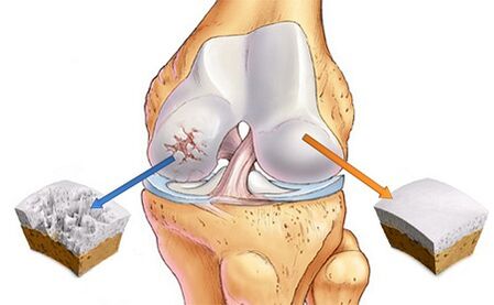 Qu'est-ce que l'arthrose de l'articulation du genou